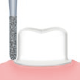 Restorative(For Preparation of crown cores)/S81D  -AIR SCALER